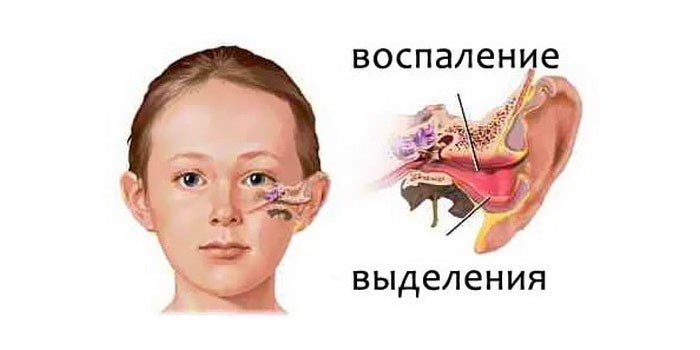 Воспаление уха