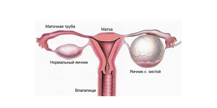 Яичник с кистой