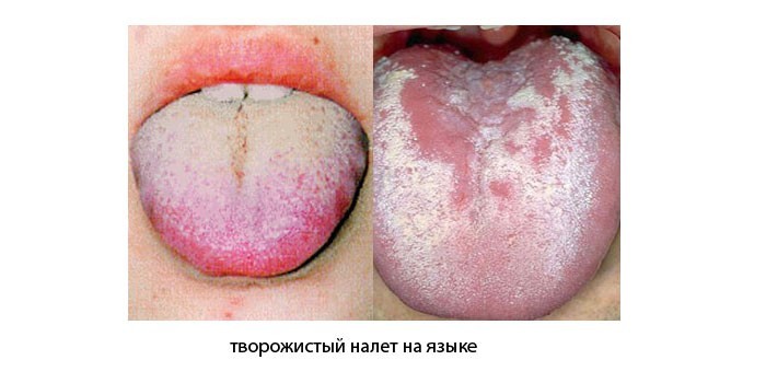 Творожистый налет на языке