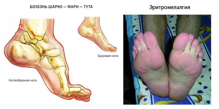 Редкие причины жжения в ногах 