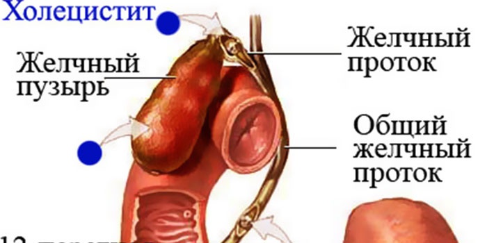 Схема холецистита