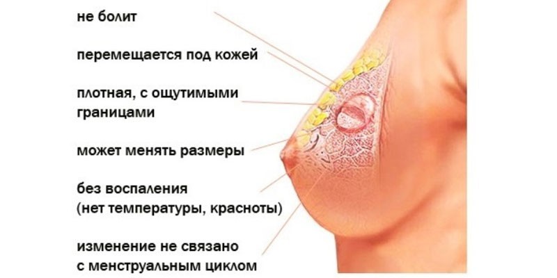 Фиброаденома молочной железы