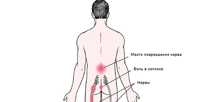 Схема поражения нерва