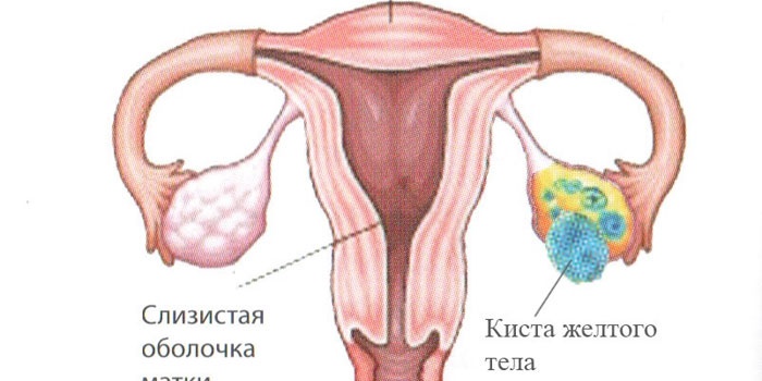 Схема кисты желтого тела