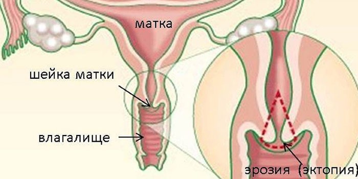 Эрозия шейки матки