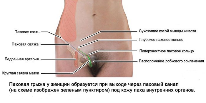 Паховая грыжа
