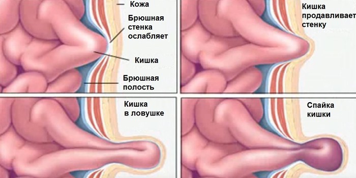 Защемление и спайки