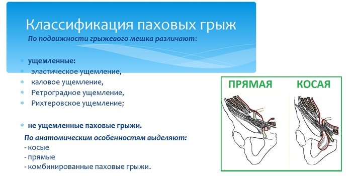Классификация паховых грыж