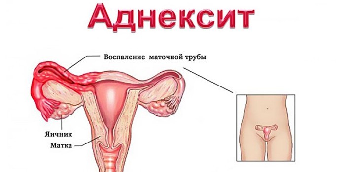 Воспаление яичников