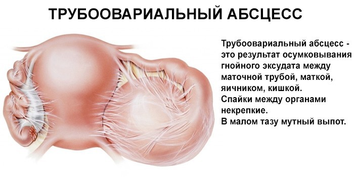 Тубоовариальный абсцесс