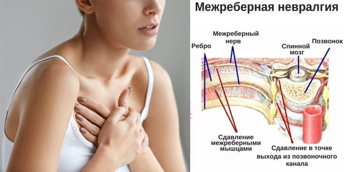 Межреберная невралгия