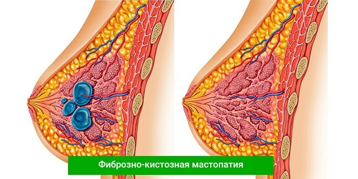 Фиброзно-кистозная мастопатия
