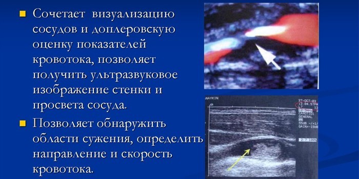 Оценка состояние сосудов дуплексным сканированием