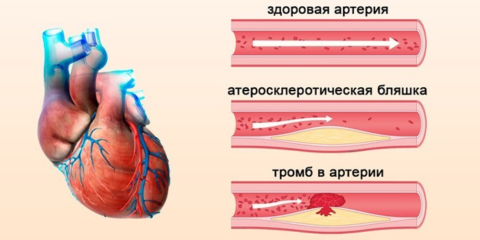 Атеросклеротическая бляшка и тромб в сосуде