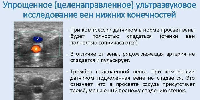 Упрощенное УЗИ вне нижних конечностей
