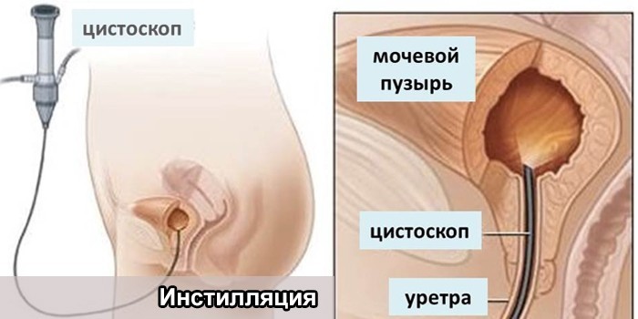 Процедура инстилляции