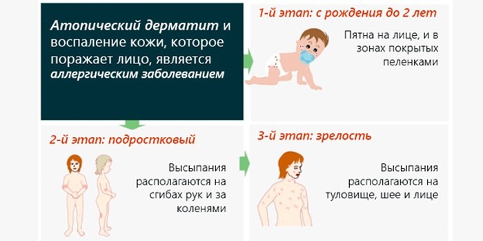 Этапы развития болезни