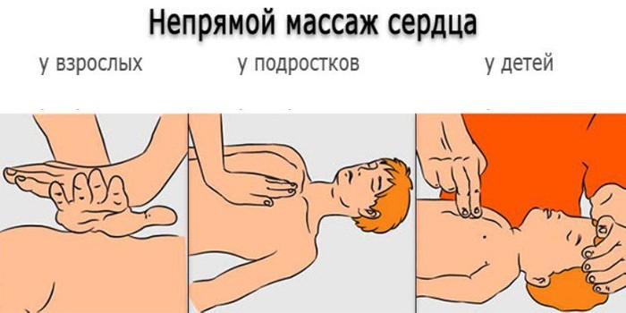 Непрямой массаж средца