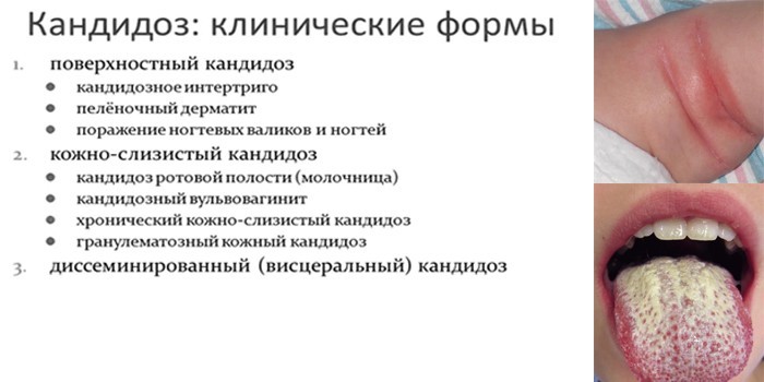 клинические формы болезни