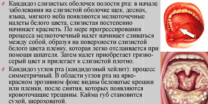 Проявления на слизистых оболочках