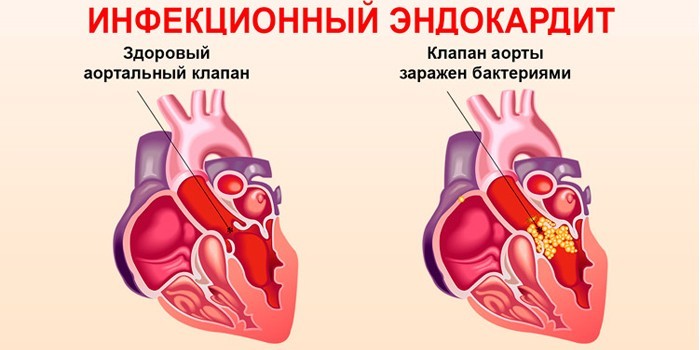 Клапан аорты сердца поражен бактериями