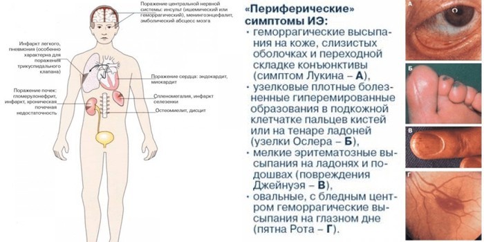 внутренние и периферические симптомы ИЭ