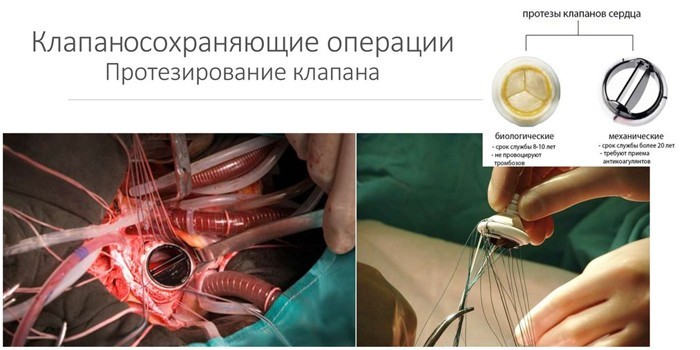 Клапаносохраняющие операции