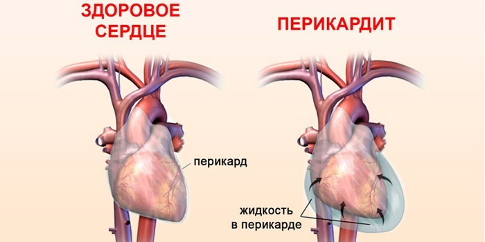 Здоровое сердце и перикардит