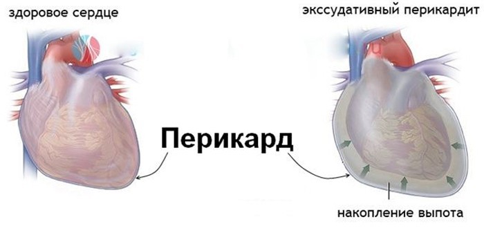 Экссудативный перикардит