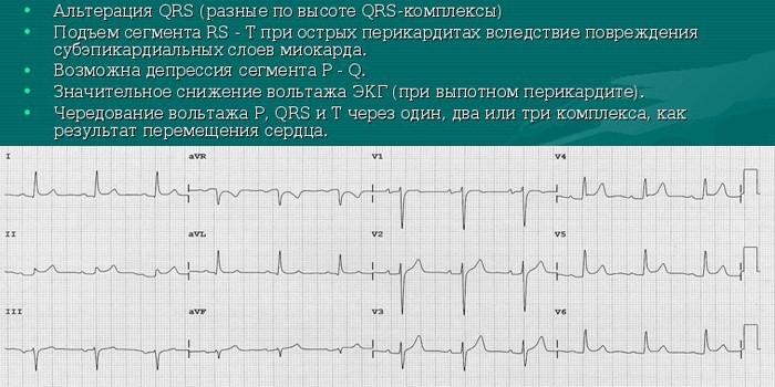 ЭКГ и расшифровка