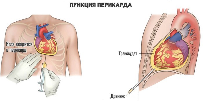 Проведение пункции