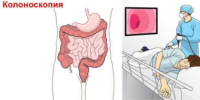 Колоноскопия