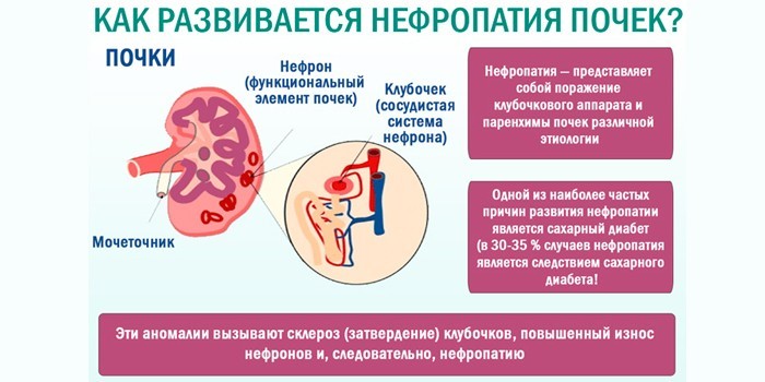 Как развивается нефропатия почек