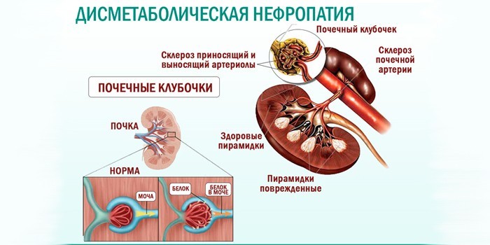 Проявления дисметаболической формы заболевания