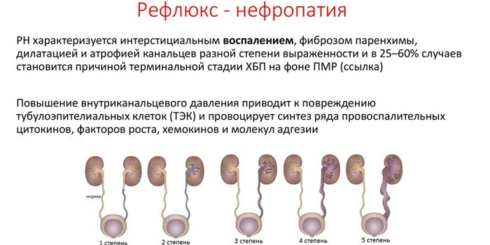 Рефлюкс-нефропатия