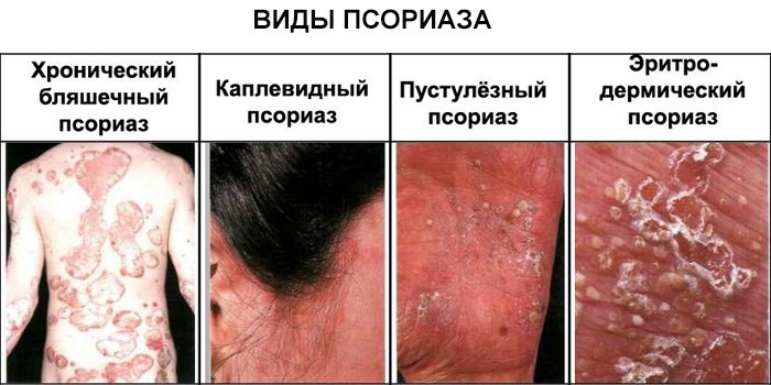 Виды псориаза
