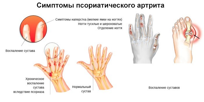 Симптомы псориатического артрита