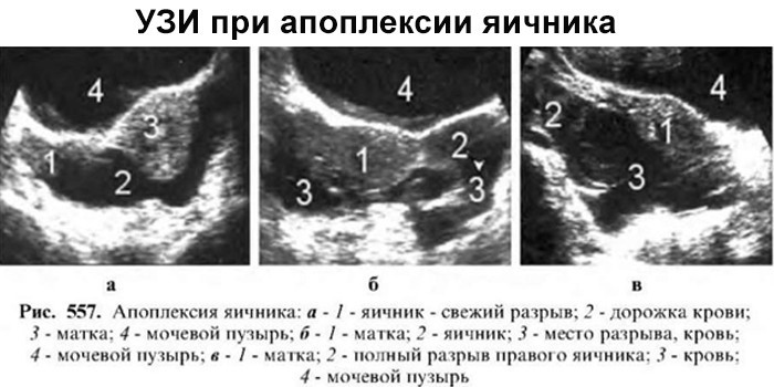 Разрыв яичника на УЗИ