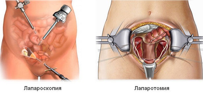 Лапаротомия и лапароскопия