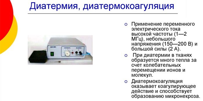 Диатермокоагуляция