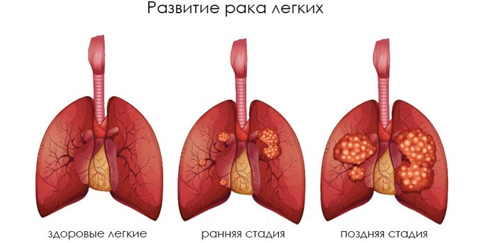 Стадии развития рака