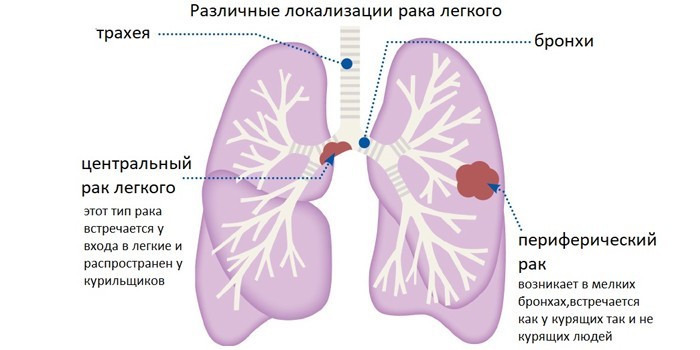 Различные локализации рака легких