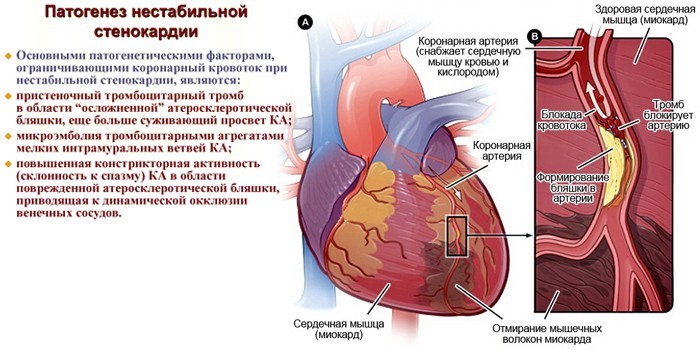 Патогенез нестабильной стенокардии