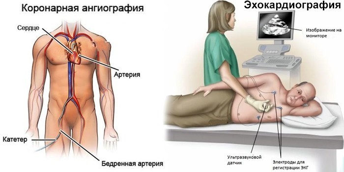 Коронарная ангиография и эхокардиография