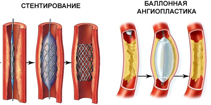 Стентирование и баллонная ангиопластика