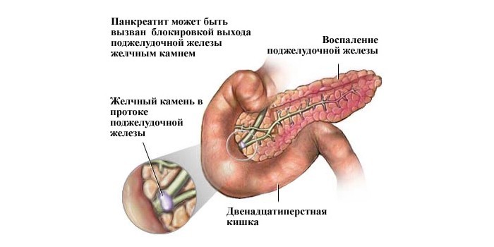Причины панкреатита