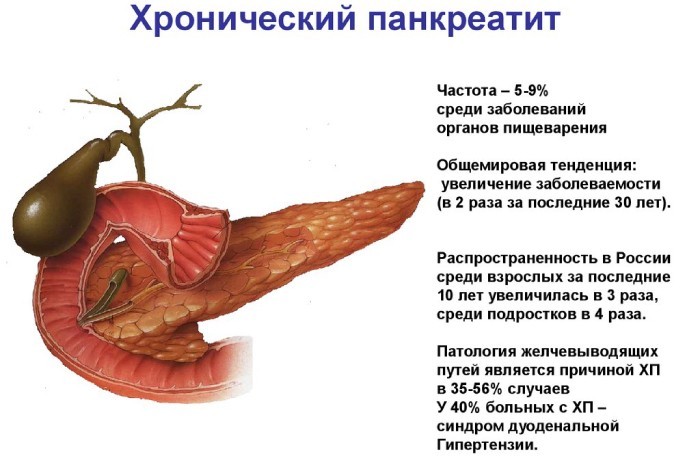 Хронический панкреатит