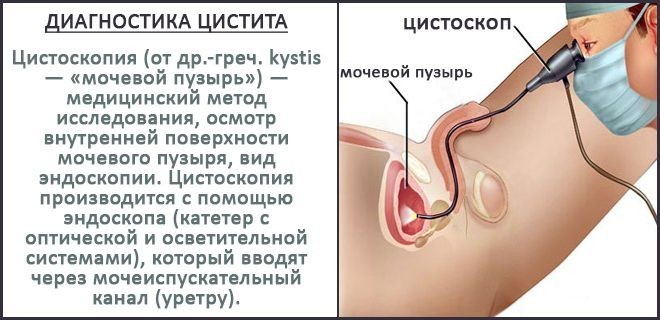 Цитоскопия для диагностики цистита