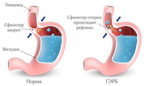 Гастроэзофагеальная рефлюксная болезнь - ГЭРБ на схеме