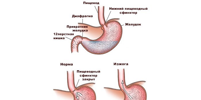 Изжога